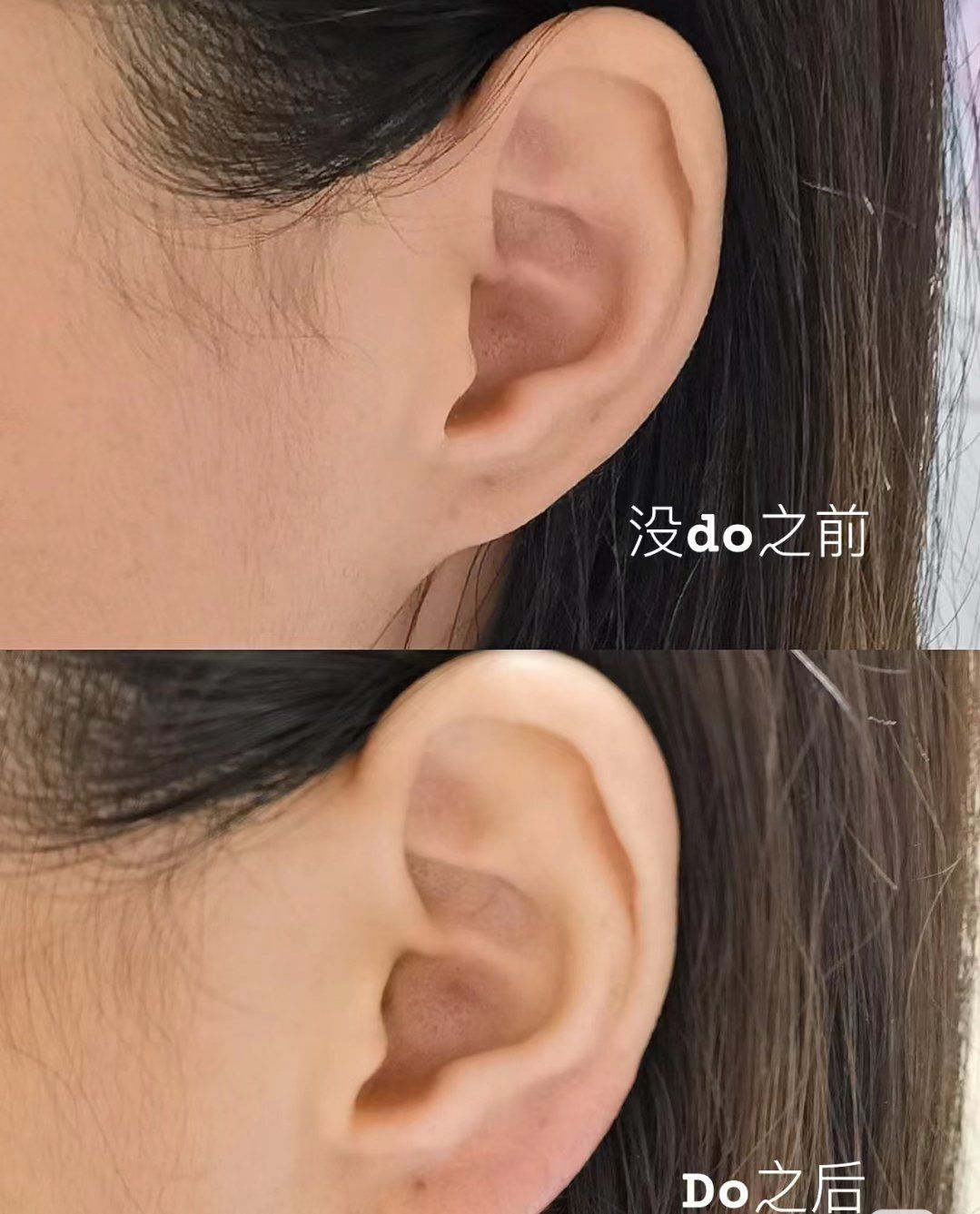 玻尿酸填充耳垂 爱住了!