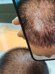 -碧莲盛·不剃发植发