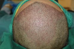 -大麦微针植发丨全国连锁