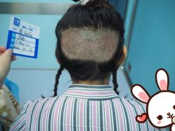 点击看大图 -大麦微针植发丨全国连锁