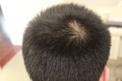 点击看大图 -大麦微针植发丨全国连锁