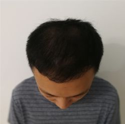 -碧莲盛·不剃发植发