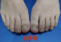 -德哥灰指甲脚气甲沟炎跖疣护理