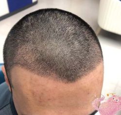 -大麦微针植发丨全国连锁