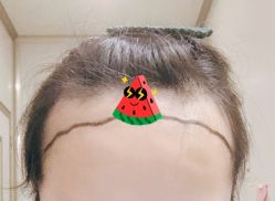 -大麦微针植发全国连锁