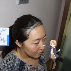 -大麦微针植发丨全国连锁