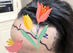 -大麦微针植发全国连锁