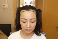 -大麦微针植发丨全国连锁