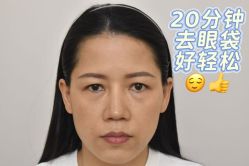 -广州健丽·去眼袋医疗美容机构