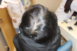 -大麦微针植发丨全国连锁