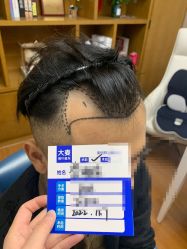 -大麦微针植发全国连锁