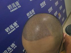 -碧莲盛·不剃发植发