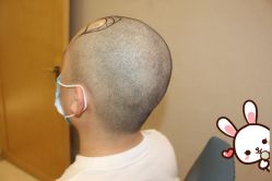 -大麦微针植发丨全国连锁