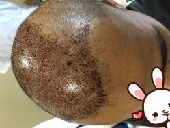 点击看大图 -大麦微针植发丨全国连锁