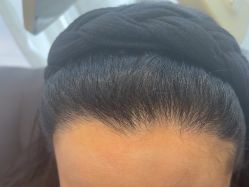 -碧莲盛·不剃发植发