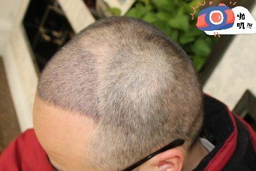 -大麦微针植发丨全国连锁