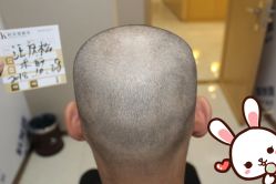 -大麦微针植发丨全国连锁