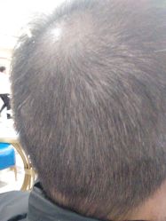 -碧莲盛·不剃发植发