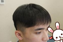 点击看大图 -大麦微针植发丨全国连锁