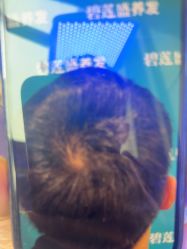 -碧莲盛·不剃发植发