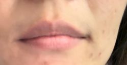 体验前-比华利美容医院