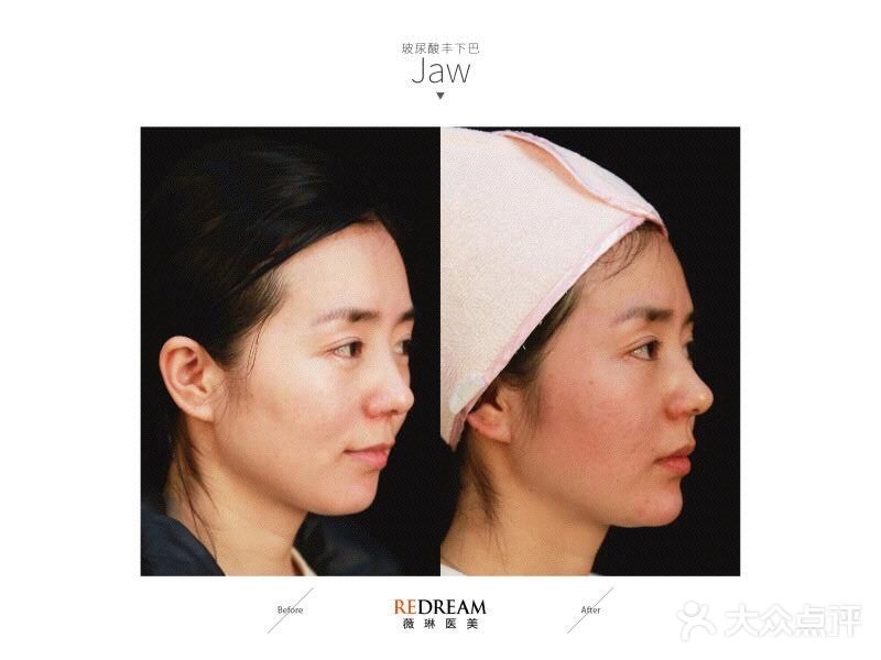 玻尿酸的功效真是太强大了！！