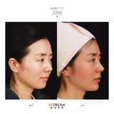 玻尿酸的功效真是太强大了！！