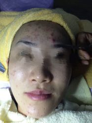 点击看大图 -苗方清颜•痘肌问题肌专研