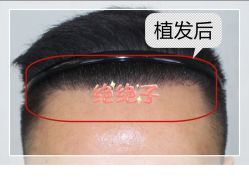 -大麦微针植发全国连锁