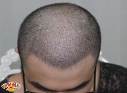 -大麦微针植发丨全国连锁