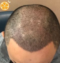 -大麦微针植发丨全国连锁