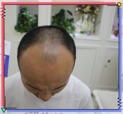 -大麦微针植发全国连锁