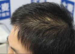-大麦微针植发丨全国连锁
