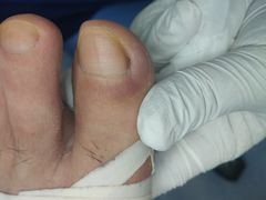 -Andrew指甲专科灰指甲·甲沟炎矫正·3D步态矫形鞋垫定制(上海法华镇路旗舰店)