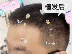 -大麦微针植发全国连锁