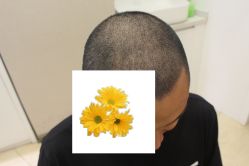 -大麦微针植发丨全国连锁
