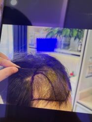 -碧莲盛·不剃发植发