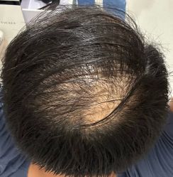 体验前-大麦微针植发全国连锁