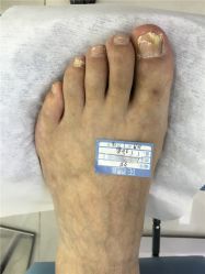 -派恩宜灰指甲鸡眼嵌甲手足癣