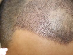 -大麦微针植发丨全国连锁