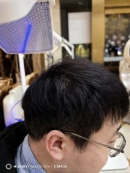 -碧莲盛·不剃发植发