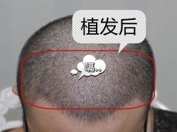 -大麦微针植发全国连锁