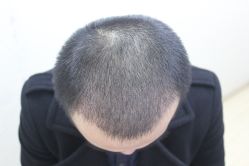 点击看大图 -大麦微针植发丨全国连锁