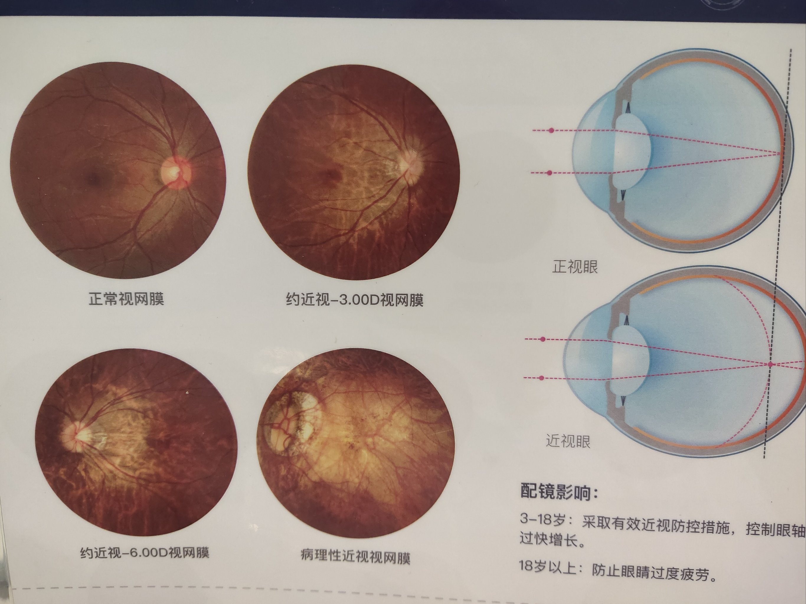 眼健康眼底检查