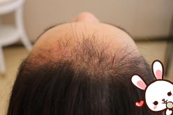 -大麦微针植发丨全国连锁