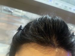 -碧莲盛·不剃发植发