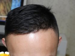 -大麦微针植发丨全国连锁