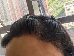 -碧莲盛·不剃发植发