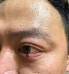 -北京美痣堂古方祛痣斑疣瘊