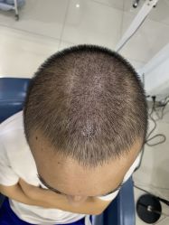 体验后-大麦微针植发全国连锁